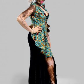 The 101 on&nbsp;vitiligo